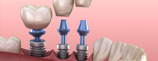 All you need to know Dental Implants Treatments in Hyderabad